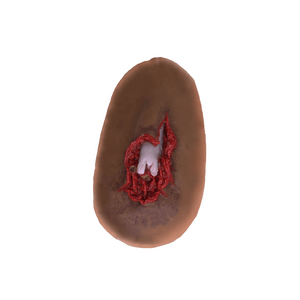 Laerdal Medical-Compound Fracture - Laerdal-MedTech-3